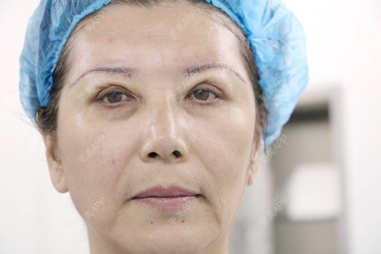 更美用户gdauqi0lxt的切眉日记