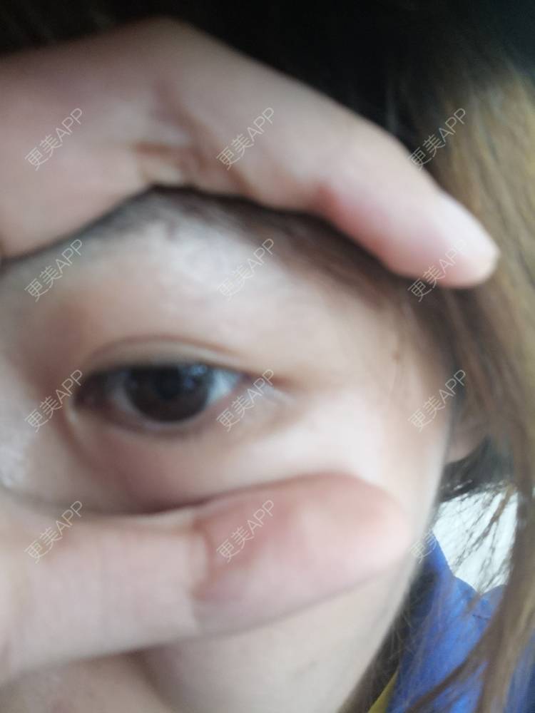 更美 - 夏夏夏S.💝的双眼皮经验 | 定点双眼皮 | 双眼皮 | 长沙 | 美购日记