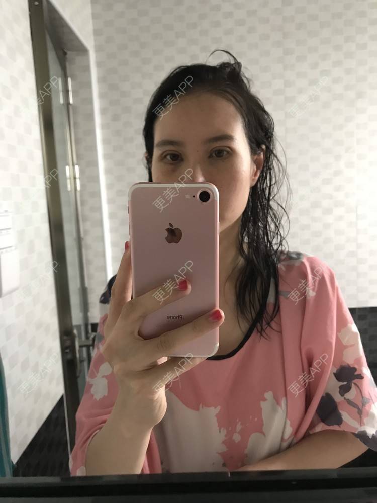 更美 - 美妘美眉的全切双眼皮经验 | 全切双眼皮 | 开内眼角 | 眼皮下垂矫正 | 长沙