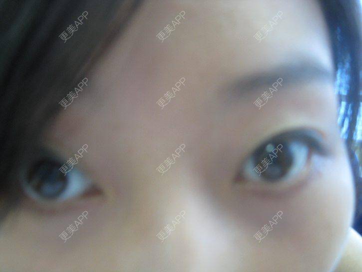 更美 - 更美用户KSWcTWq2QB的外切去眼袋经验 | 成都 | 外切去眼袋