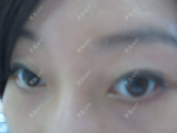 更美 - 更美用户KSWcTWq2QB的外切去眼袋经验 | 成都 | 外切去眼袋