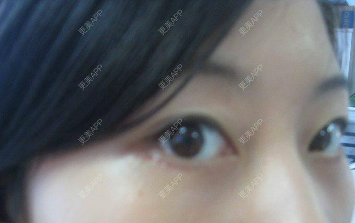 更美 - 更美用户KSWcTWq2QB的外切去眼袋经验 | 成都 | 外切去眼袋