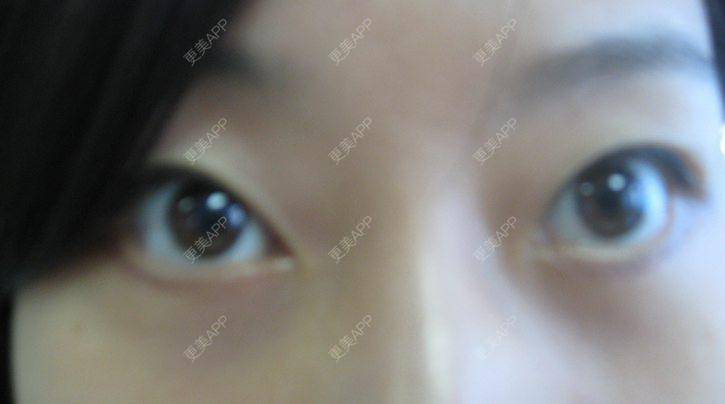 更美 - 更美用户KSWcTWq2QB的外切去眼袋经验 | 成都 | 外切去眼袋