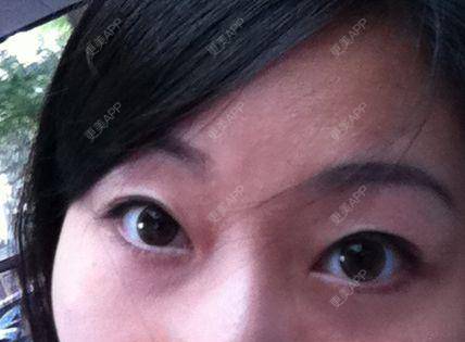 更美 - 更美用户KSWcTWq2QB的外切去眼袋经验 | 成都 | 外切去眼袋