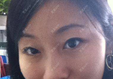 更美 - 更美用户KSWcTWq2QB的外切去眼袋经验 | 成都 | 外切去眼袋