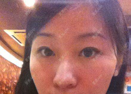 更美 - 更美用户KSWcTWq2QB的外切去眼袋经验 | 成都 | 外切去眼袋