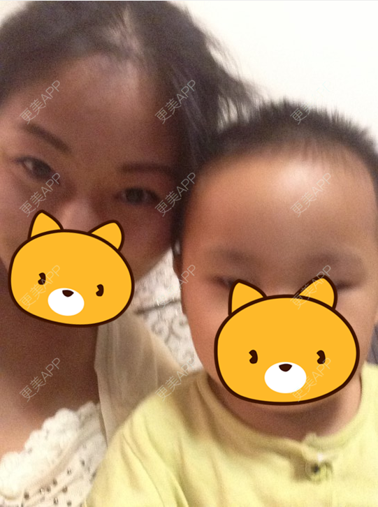 更美 - 更美用户KSWcTWq2QB的外切去眼袋经验 | 成都 | 外切去眼袋