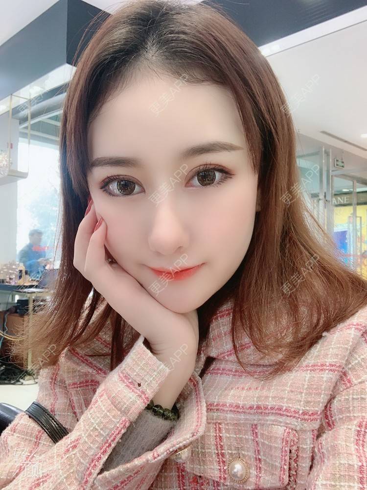 更美 - 火锅最爱小丸子的自体脂肪填充泪沟经验 | 自体脂肪填充泪沟 | 自体脂肪垫鼻基底 | 重庆 | 自体脂肪丰苹果肌 | 自体脂肪丰额头 | 自体脂肪全面部填充