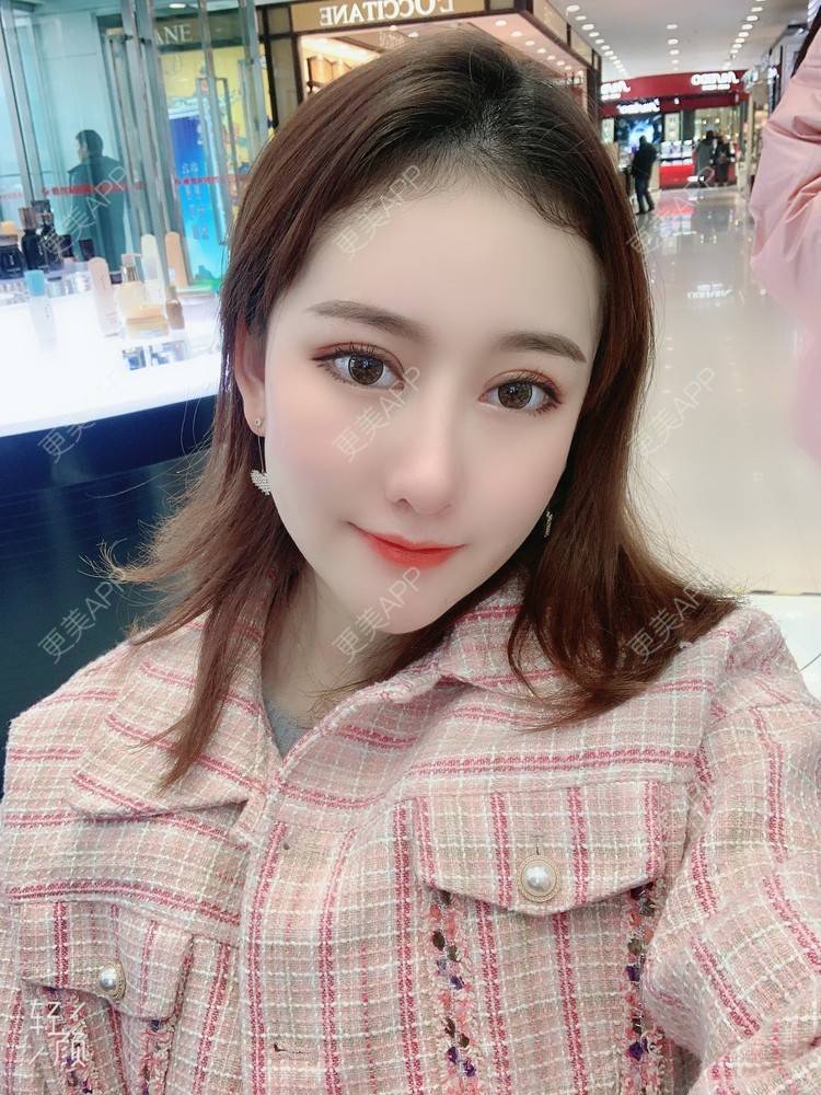 更美 - 火锅最爱小丸子的自体脂肪填充泪沟经验 | 自体脂肪填充泪沟 | 自体脂肪垫鼻基底 | 重庆 | 自体脂肪丰苹果肌 | 自体脂肪丰额头 | 自体脂肪全面部填充