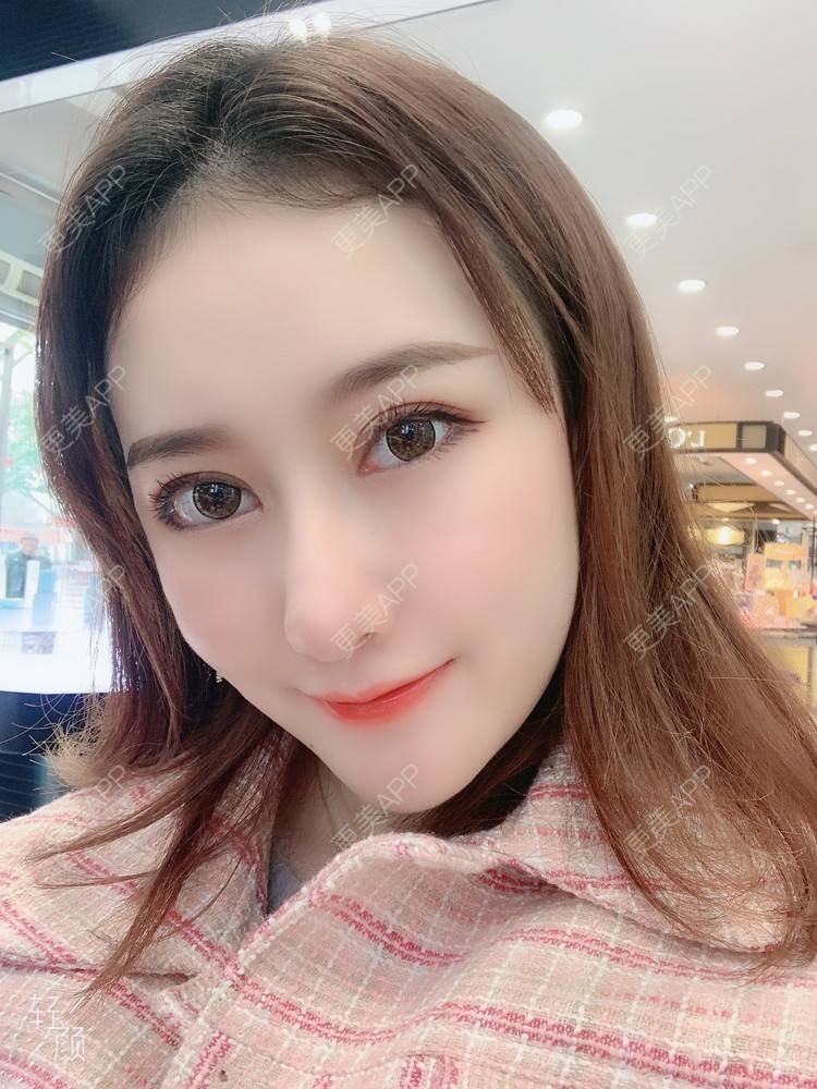 更美 - 火锅最爱小丸子的自体脂肪填充泪沟经验 | 自体脂肪填充泪沟 | 自体脂肪垫鼻基底 | 重庆 | 自体脂肪丰苹果肌 | 自体脂肪丰额头 | 自体脂肪全面部填充