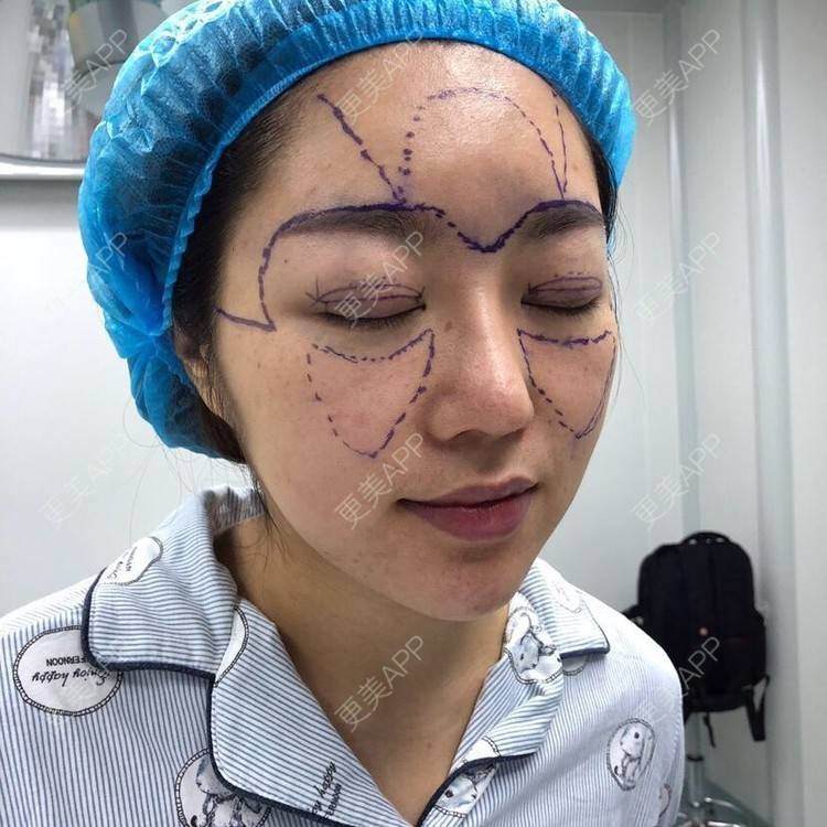更美 - 身野心安稳压的自体脂肪填充颈纹经验 | 自体脂肪填充颈纹 | 长沙