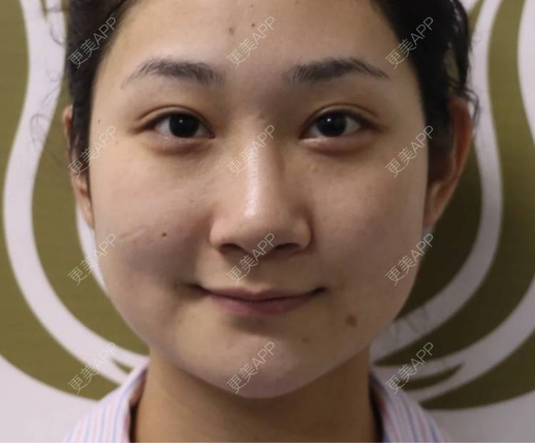 更美 - 南京顾泽门诊部的硅胶隆鼻经验 | 耳软骨隆鼻 | 硅胶隆鼻 | 鼻翼缩小 | 南京