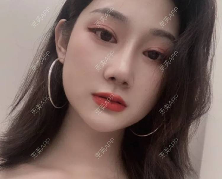 更美 - 南京顾泽门诊部的硅胶隆鼻经验 | 耳软骨隆鼻 | 硅胶隆鼻 | 鼻翼缩小 | 南京