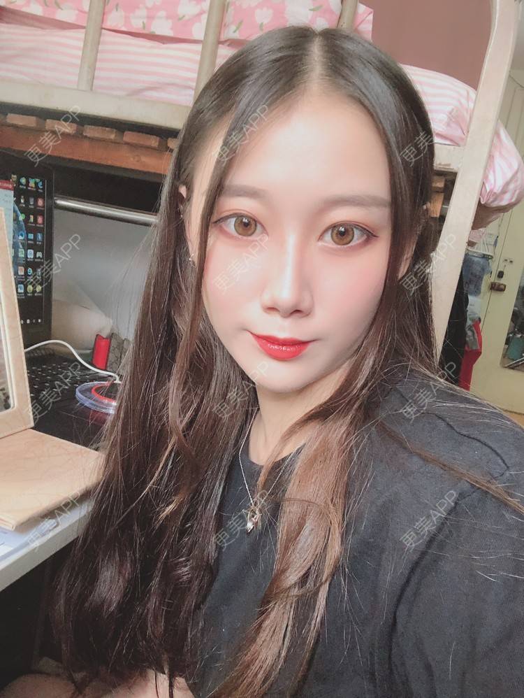 更美 - 更美用户V3kfqQBbsI的膨体垫下巴经验 | 上海 | 膨体垫下巴