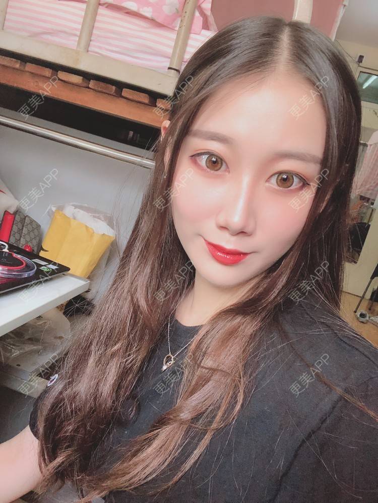 更美 - 更美用户V3kfqQBbsI的膨体垫下巴经验 | 上海 | 膨体垫下巴