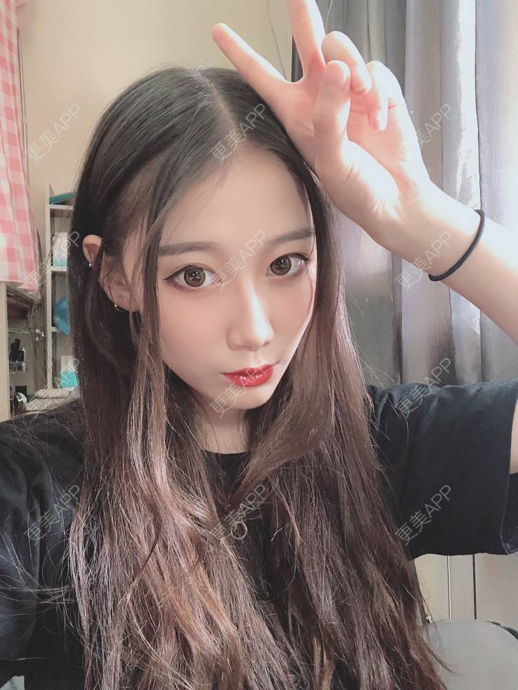 更美 - 更美用户V3kfqQBbsI的膨体垫下巴经验 | 上海 | 膨体垫下巴