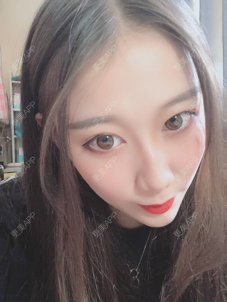 更美 - 更美用户V3kfqQBbsI的膨体垫下巴经验 | 上海 | 膨体垫下巴