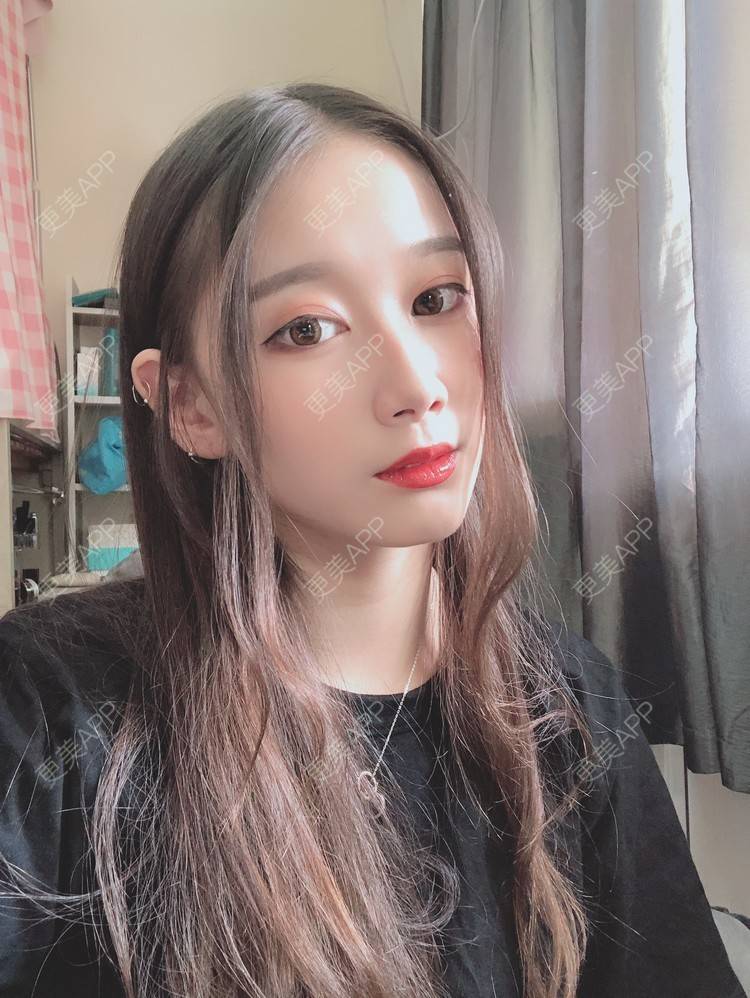 更美 - 更美用户V3kfqQBbsI的膨体垫下巴经验 | 上海 | 膨体垫下巴