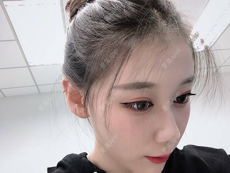 更美 - 更美用户V3kfqQBbsI的膨体垫下巴经验 | 上海 | 膨体垫下巴