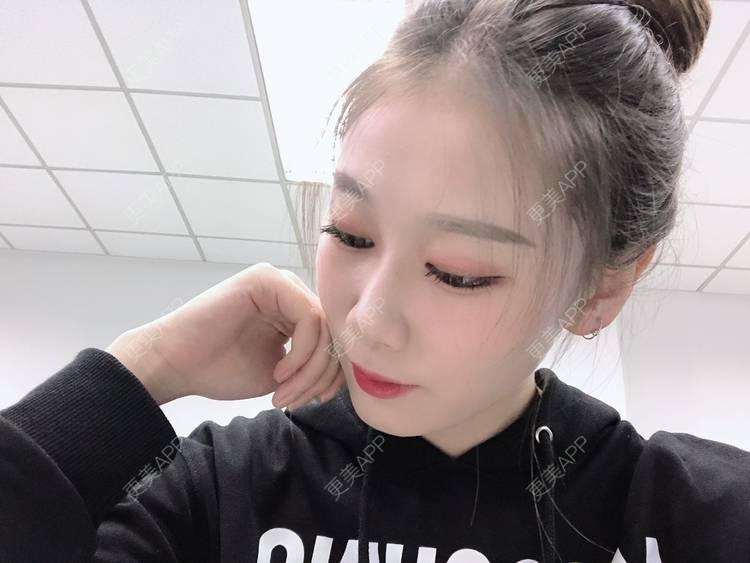 更美 - 更美用户V3kfqQBbsI的膨体垫下巴经验 | 上海 | 膨体垫下巴