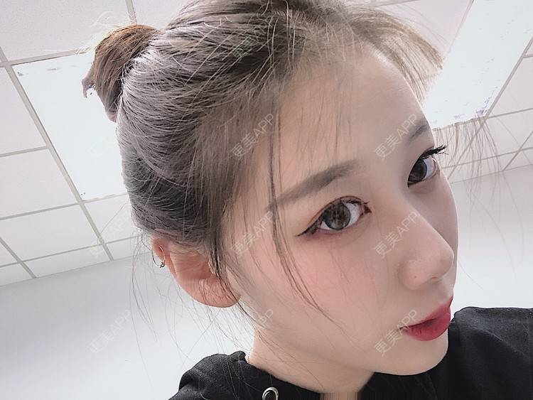 更美 - 更美用户V3kfqQBbsI的膨体垫下巴经验 | 上海 | 膨体垫下巴