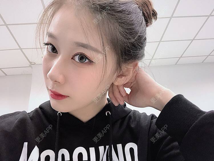 更美 - 更美用户V3kfqQBbsI的膨体垫下巴经验 | 上海 | 膨体垫下巴