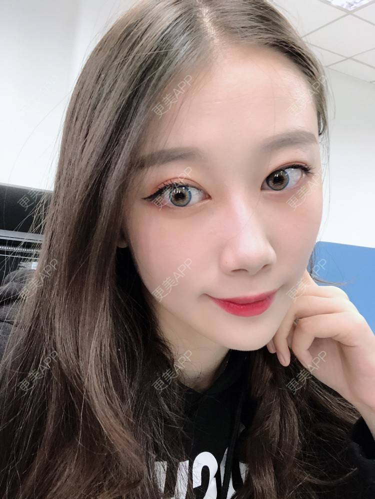 更美 - 更美用户V3kfqQBbsI的膨体垫下巴经验 | 上海 | 膨体垫下巴