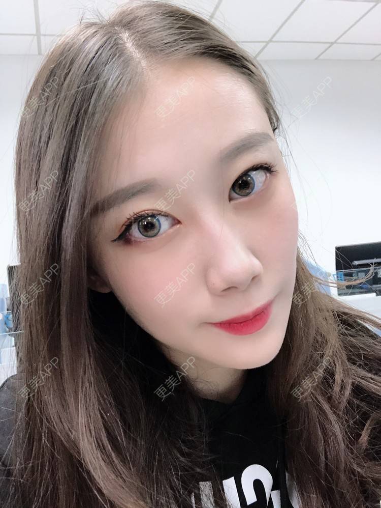 更美 - 更美用户V3kfqQBbsI的膨体垫下巴经验 | 上海 | 膨体垫下巴