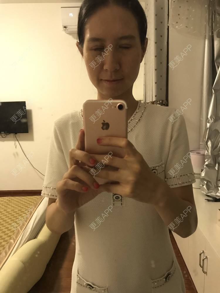 更美 - 美妘美眉的全切双眼皮经验 | 全切双眼皮 | 开内眼角 | 眼皮下垂矫正 | 长沙