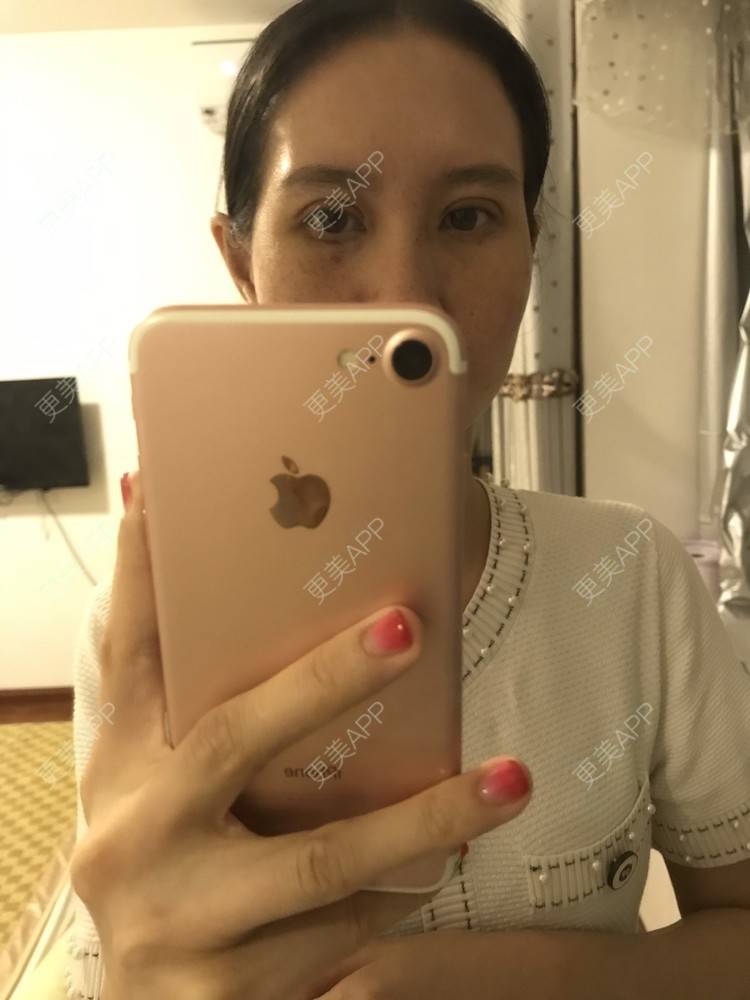 更美 - 美妘美眉的全切双眼皮经验 | 全切双眼皮 | 开内眼角 | 眼皮下垂矫正 | 长沙