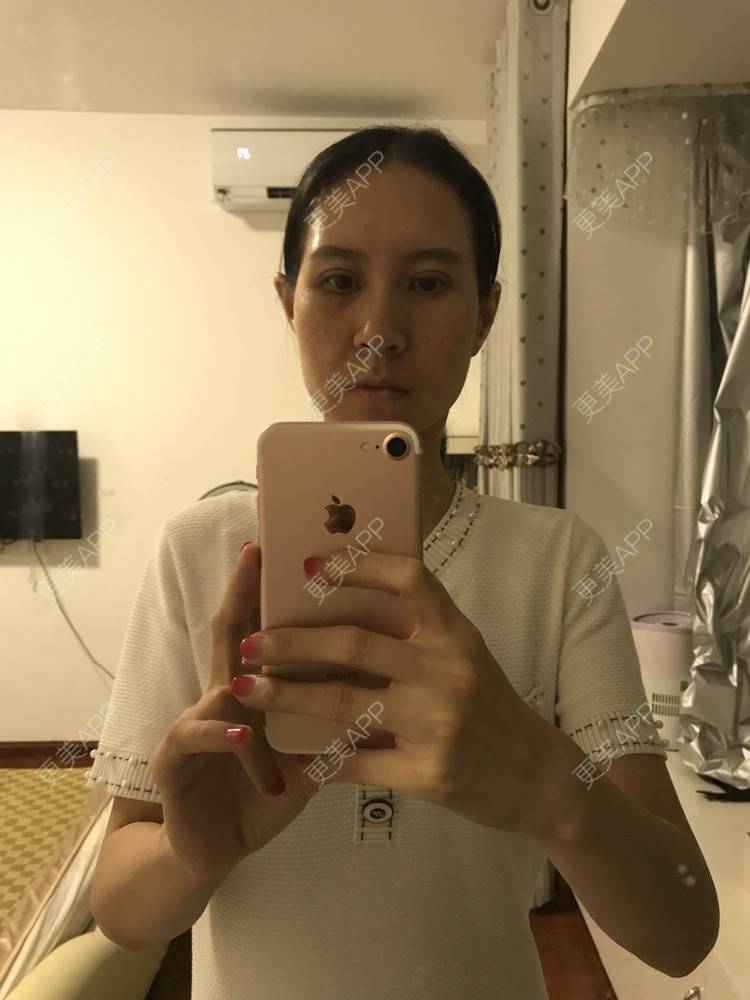 更美 - 美妘美眉的全切双眼皮经验 | 全切双眼皮 | 开内眼角 | 眼皮下垂矫正 | 长沙