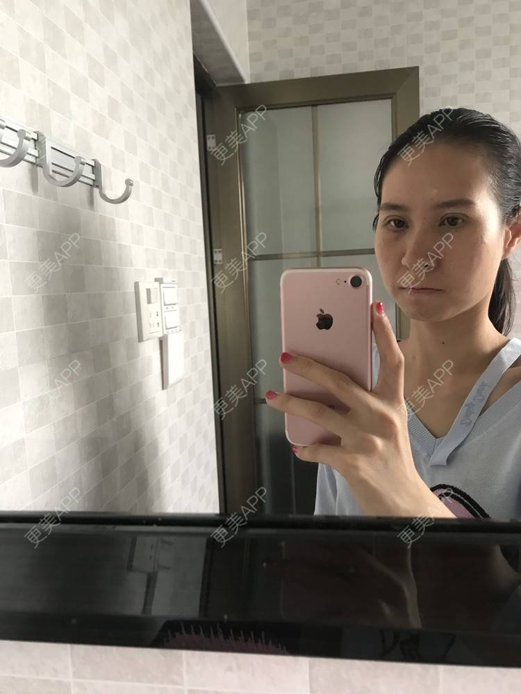 更美 - 美妘美眉的全切双眼皮经验 | 全切双眼皮 | 开内眼角 | 眼皮下垂矫正 | 长沙