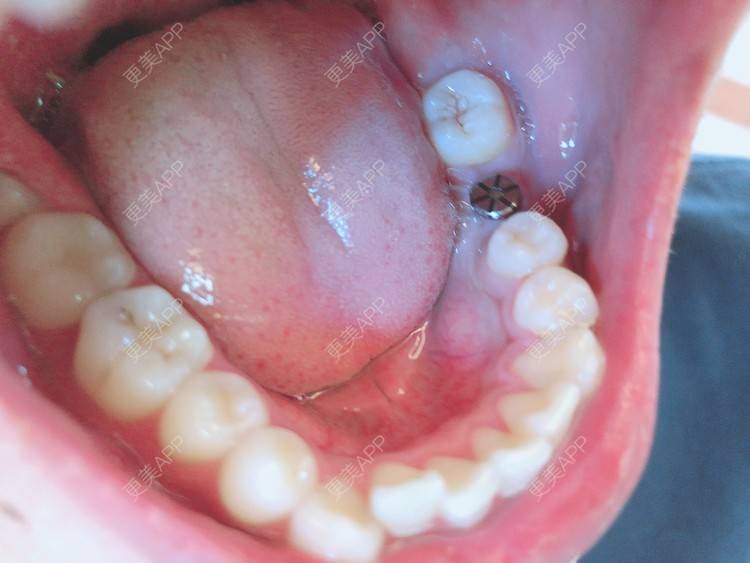 更美 - 金融财经学院(小雍)的种植牙日记 | 种植牙 | 成都 | 种植牙齿