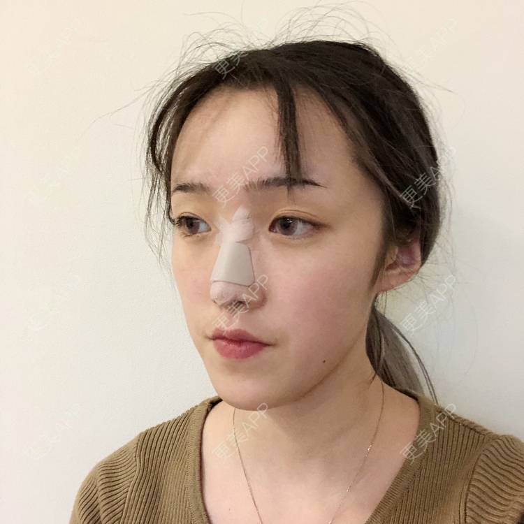 更美 - 更美用户5LnnwSf1yf的鼻部多项经验 | 中山 | 鼻部多项