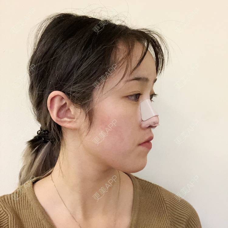 更美 - 更美用户5LnnwSf1yf的鼻部多项经验 | 中山 | 鼻部多项