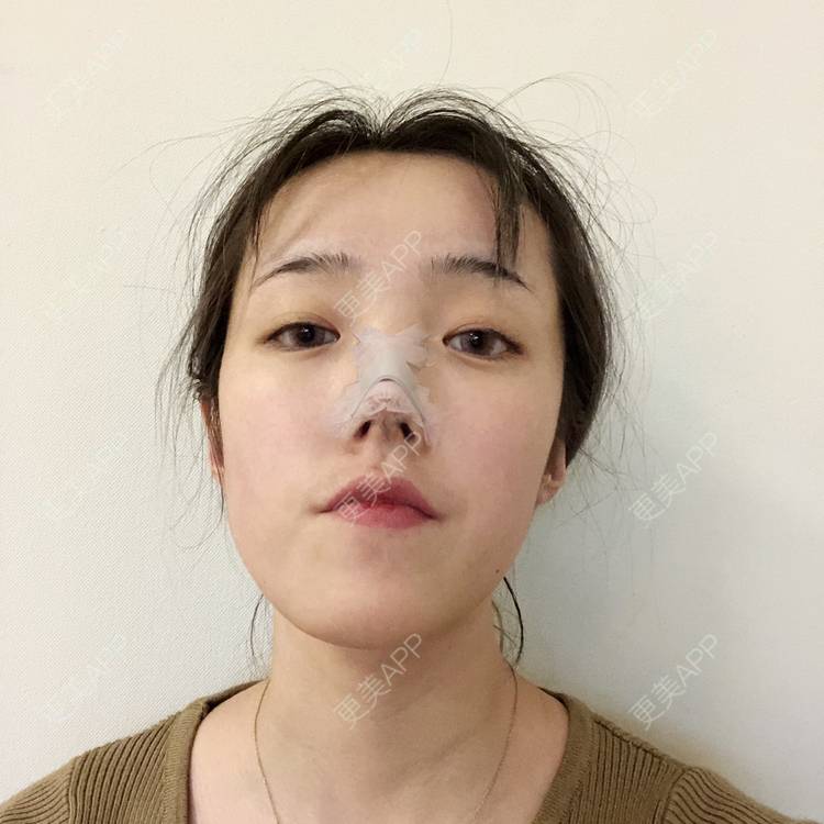 更美 - 更美用户5LnnwSf1yf的鼻部多项经验 | 中山 | 鼻部多项
