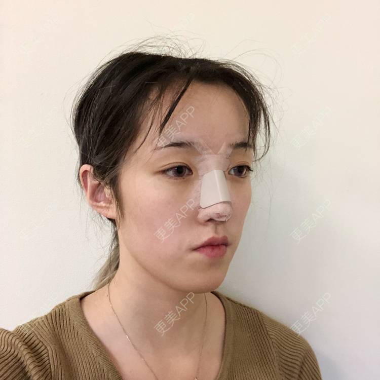 更美 - 更美用户5LnnwSf1yf的鼻部多项经验 | 中山 | 鼻部多项