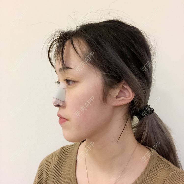 更美 - 更美用户5LnnwSf1yf的鼻部多项经验 | 中山 | 鼻部多项