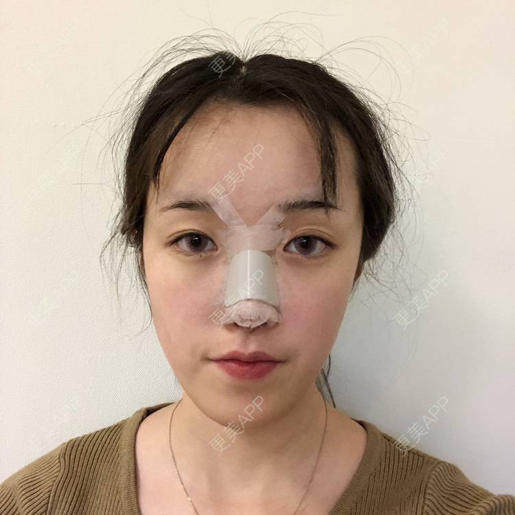 更美 - 更美用户5LnnwSf1yf的鼻部多项经验 | 中山 | 鼻部多项
