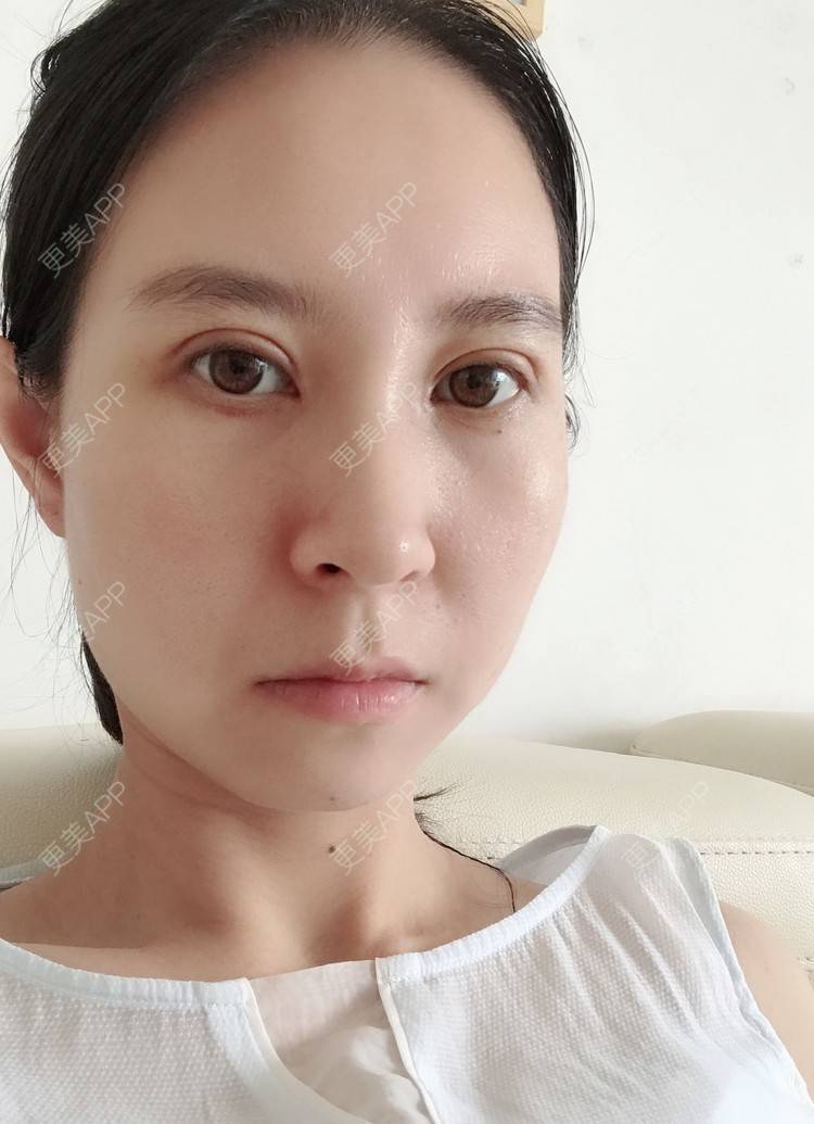 更美 - 美妘美眉的全切双眼皮经验 | 全切双眼皮 | 开内眼角 | 眼皮下垂矫正 | 长沙