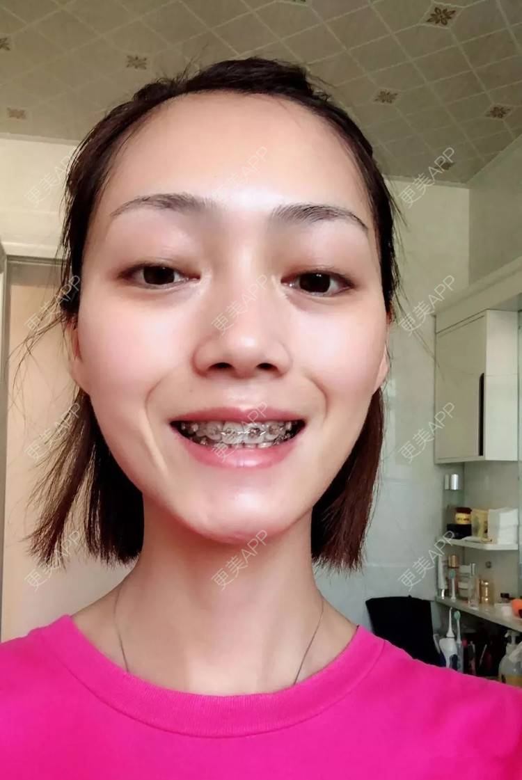 更美用户tdlawuj3ol的牙齿整形日记