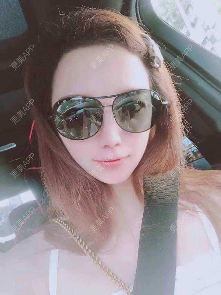 更美 - 更美用户EWqDuvHmIb的自体脂肪丰面颊经验 | 自体脂肪丰面颊 | 成都