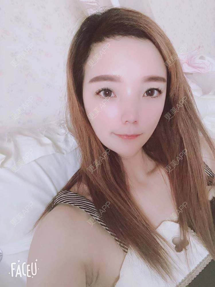更美 - 更美用户EWqDuvHmIb的自体脂肪丰面颊经验 | 自体脂肪丰面颊 | 成都