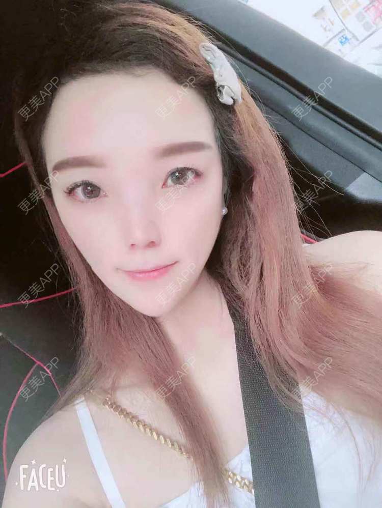 更美 - 更美用户EWqDuvHmIb的自体脂肪丰面颊经验 | 自体脂肪丰面颊 | 成都