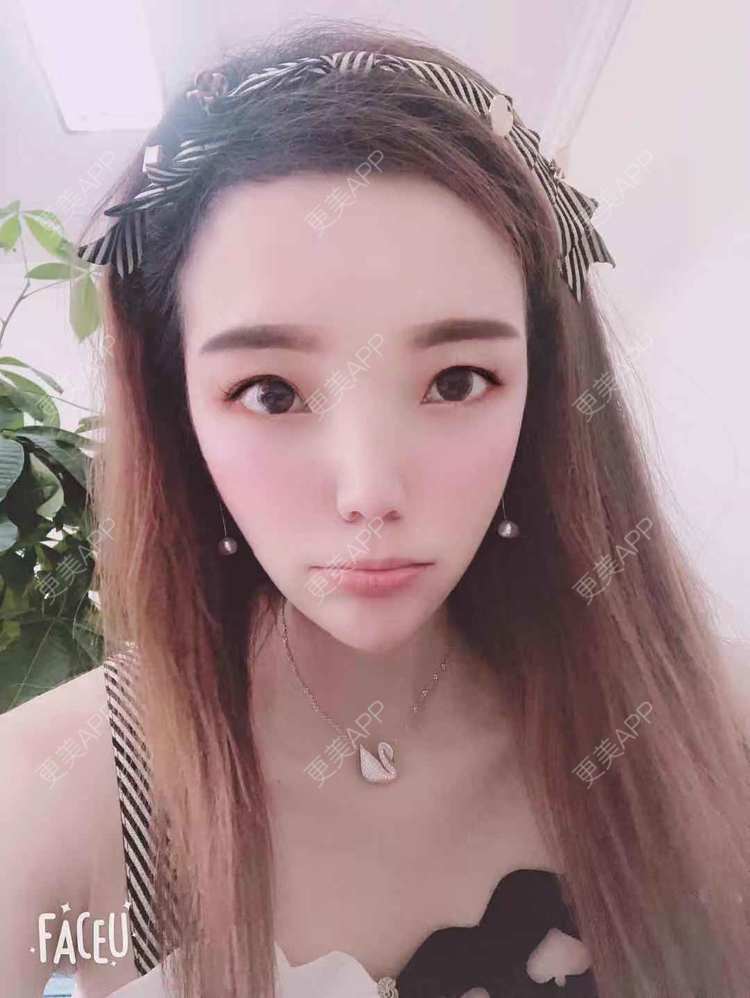更美 - 更美用户EWqDuvHmIb的自体脂肪丰面颊经验 | 自体脂肪丰面颊 | 成都