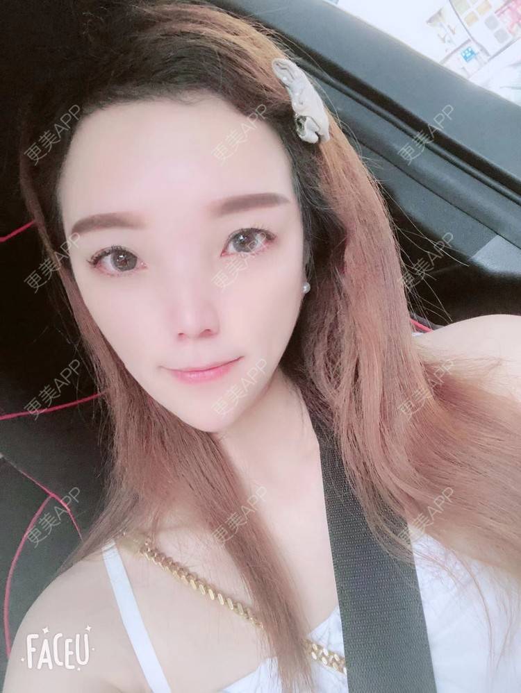 更美 - 更美用户EWqDuvHmIb的自体脂肪丰面颊经验 | 自体脂肪丰面颊 | 成都
