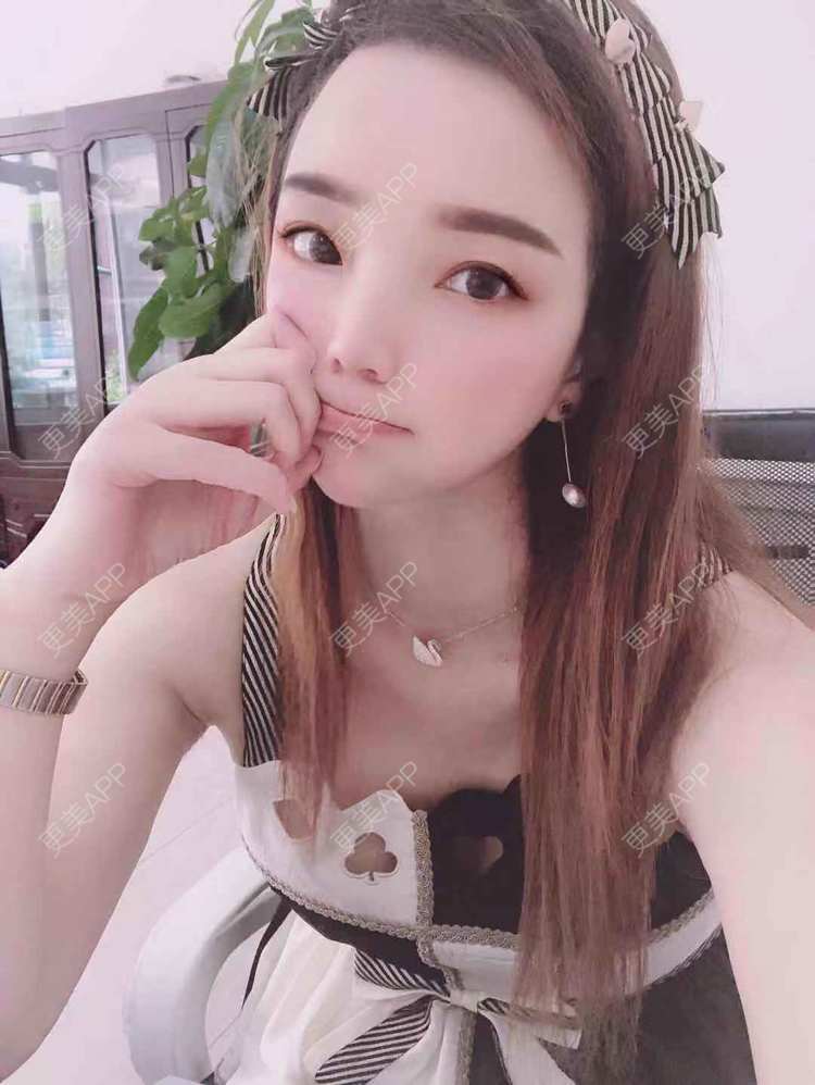 更美 - 更美用户EWqDuvHmIb的自体脂肪丰面颊经验 | 自体脂肪丰面颊 | 成都