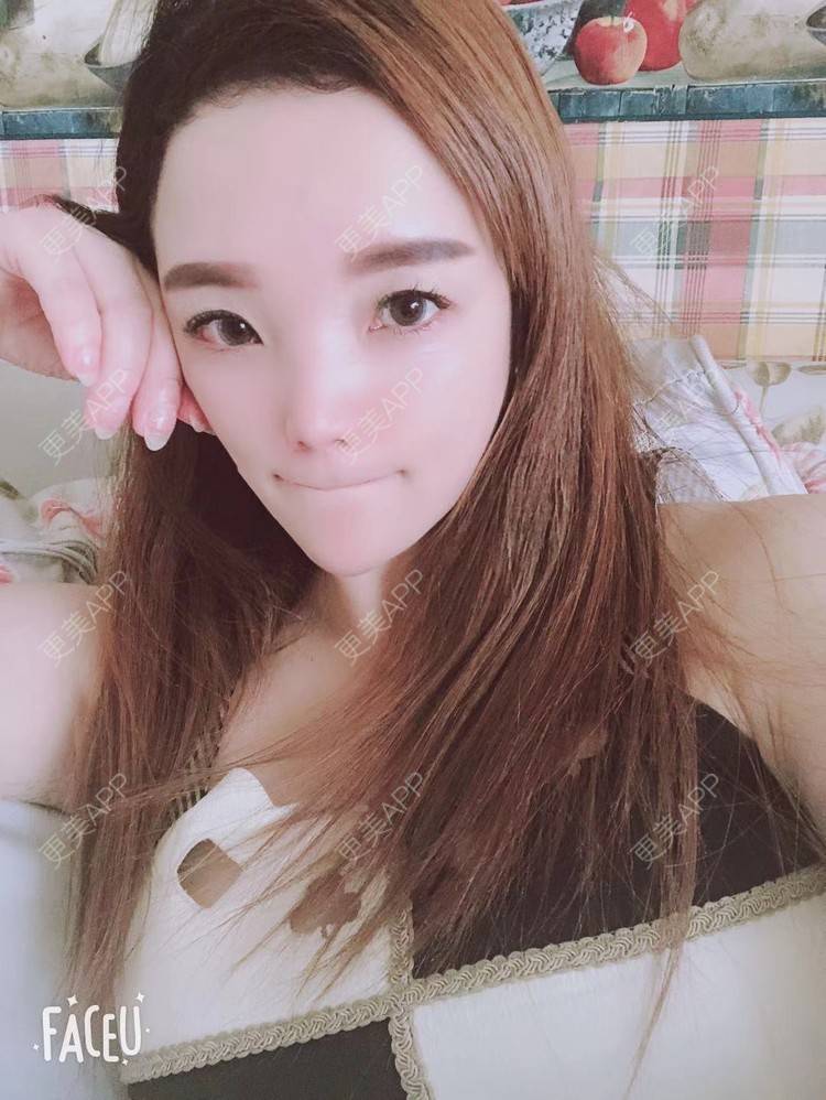 更美 - 更美用户EWqDuvHmIb的自体脂肪丰面颊经验 | 自体脂肪丰面颊 | 成都