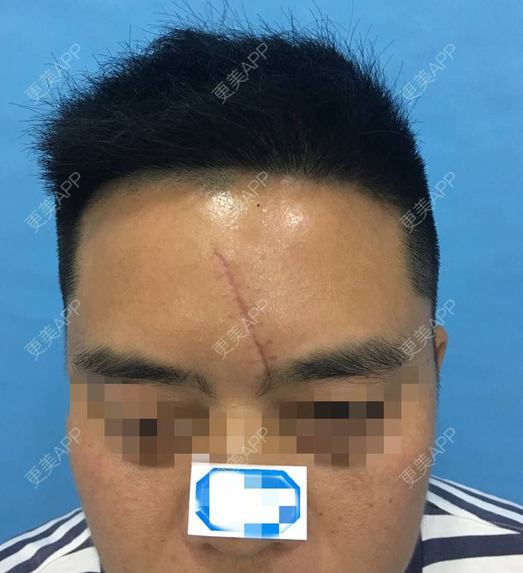 更美 - 高元宗 医生的激光淡疤经验 | 激光淡疤 | 上海