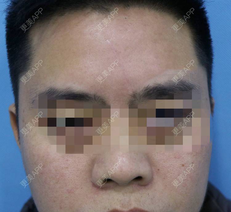 更美 - 高元宗 医生的激光淡疤经验 | 激光淡疤 | 上海